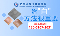 辽宁白癜风医院